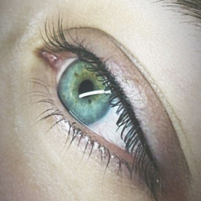 Межресничка